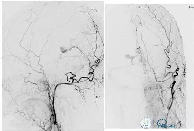 球囊辅助Onyx栓塞治疗硬脑膜动静脉瘘（DAVF）