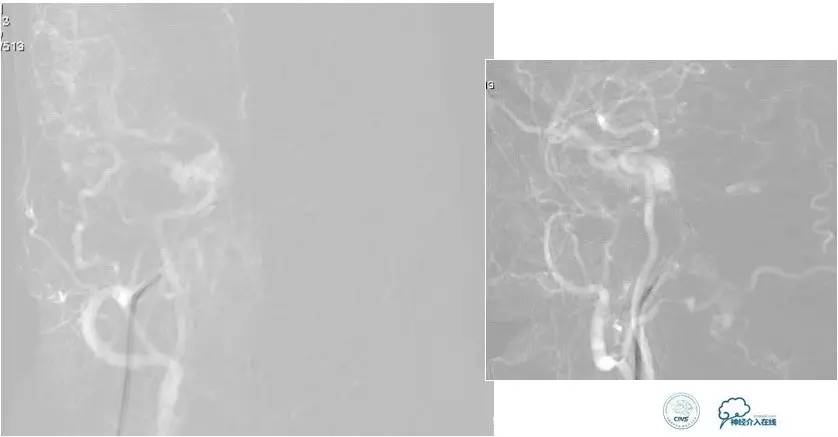 球囊辅助Onyx栓塞治疗硬脑膜动静脉瘘（DAVF）