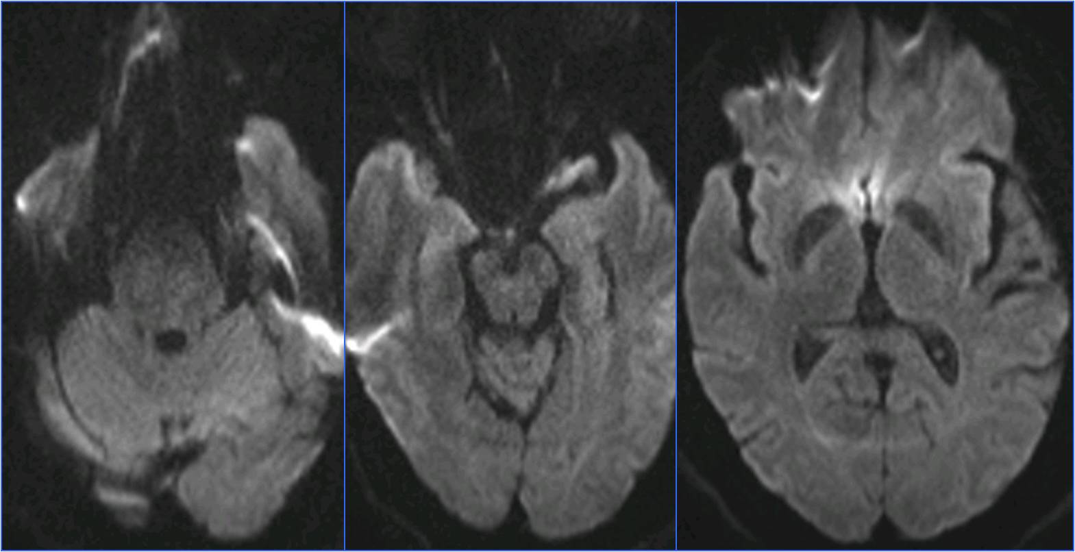 缺血性脑卒中术后管理,急性缺血性脑卒中血管内治疗