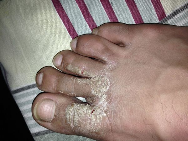 治脚癣手癣最有效的偏方,除去脚癣的中药有什么