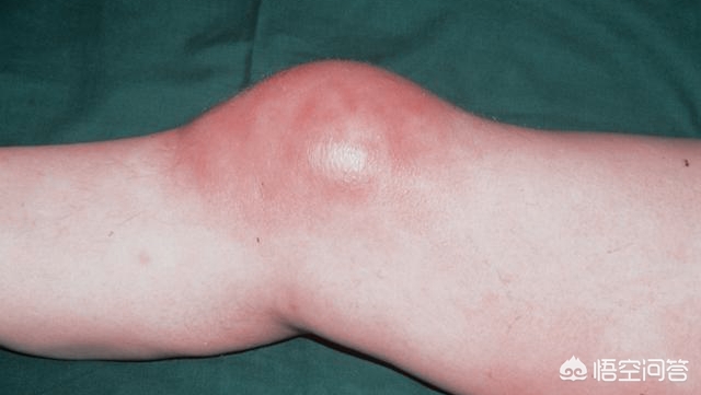 髌股关节软骨损伤能完全治愈吗,髌股骨软骨损伤