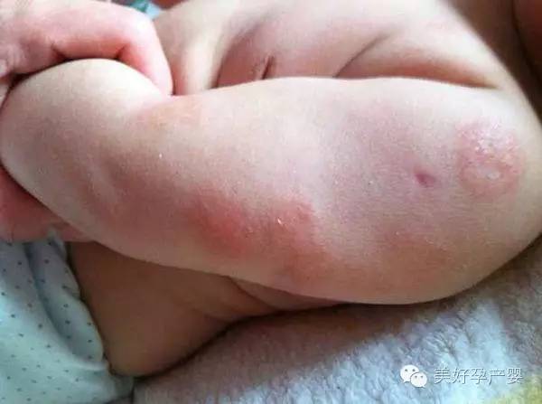 湿疹宝宝不要怕教你几招,湿疹千万别涂保湿霜