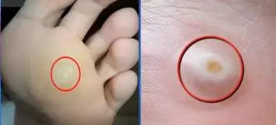 从脚看出疾病征兆,脚型不好看是怎么回事