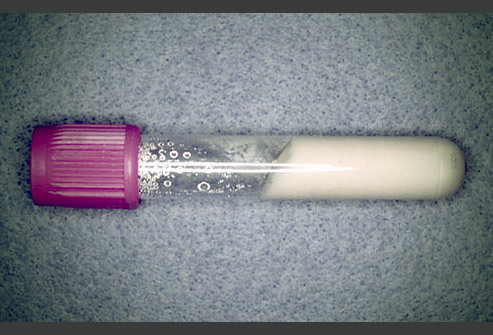 痛风的原因是什么临床是如何治疗,手指痛风的症状和治疗