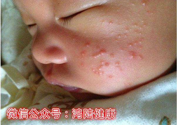 宝宝鹅口疮脸上长满红疹为什么,7个月宝宝鹅口疮最佳治疗方法