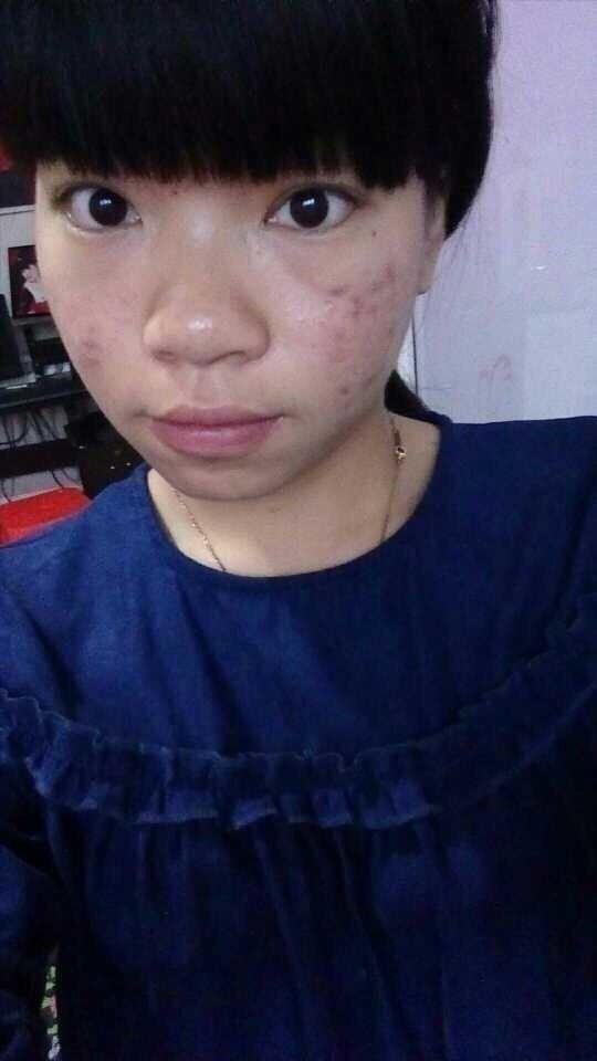 祛痘痘祛痘印推荐学生党11岁,简单又实用的祛痘方法