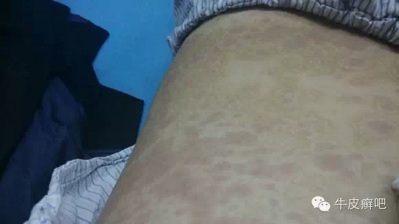 医院专家教你治疗牛皮癣,专家专治牛皮癣方法