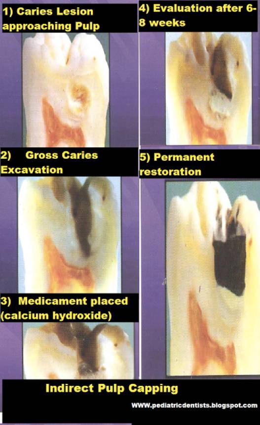 牙神经坏了根管治疗,牙神经坏了有修复的方法吗