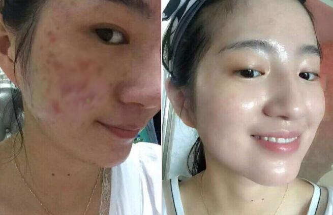 脖子上的痘痘反复发作,一个地方痘痘反复发作