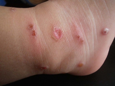 孩子身上起红疙瘩很痒什么情况,身上起红疙瘩还痒图片