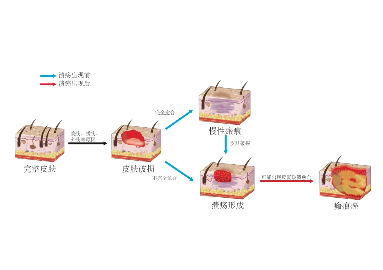 瘢痕疙瘩与瘢痕癌变的区别,瘢痕癌变症状