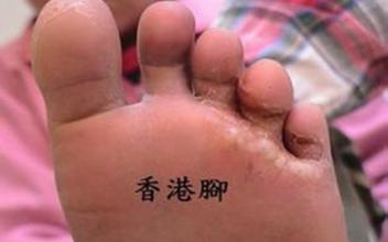 脚气怎么办教你除根最简单方法,脚气反反复复如何去断根