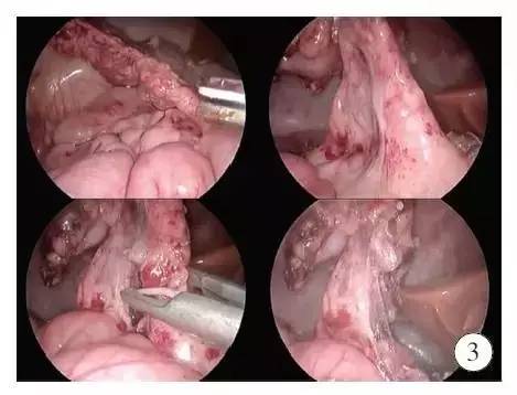 手术演示肠造口术后单切口腹腔镜辅助巨结肠根治术（Duhame1术）