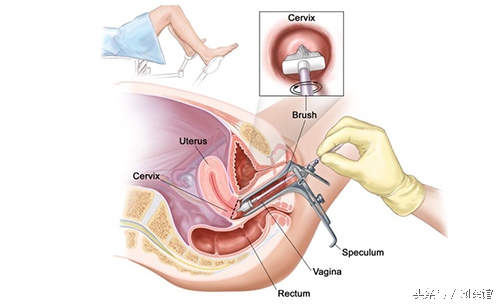 妇科宫颈癌疫苗,宫颈癌疫苗能预防哪些妇科病