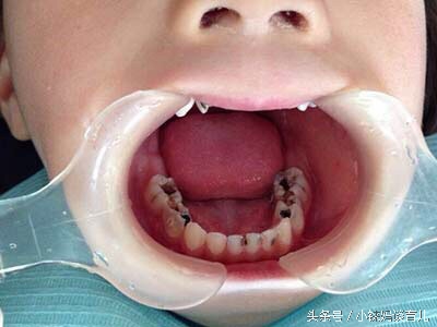 儿童乳牙龋齿烂了有必要补牙吗,乳牙蛀了是套牙套还是补牙