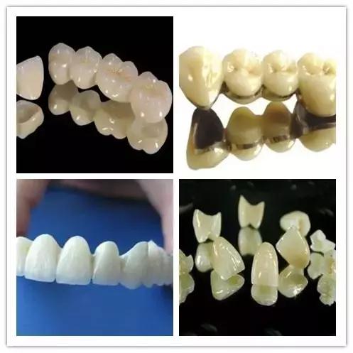 各类烤瓷牙优缺点,烤瓷牙质量保证卡