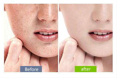 脸上长雀斑有损“面子工程”，民间偏方帮你回归颜值