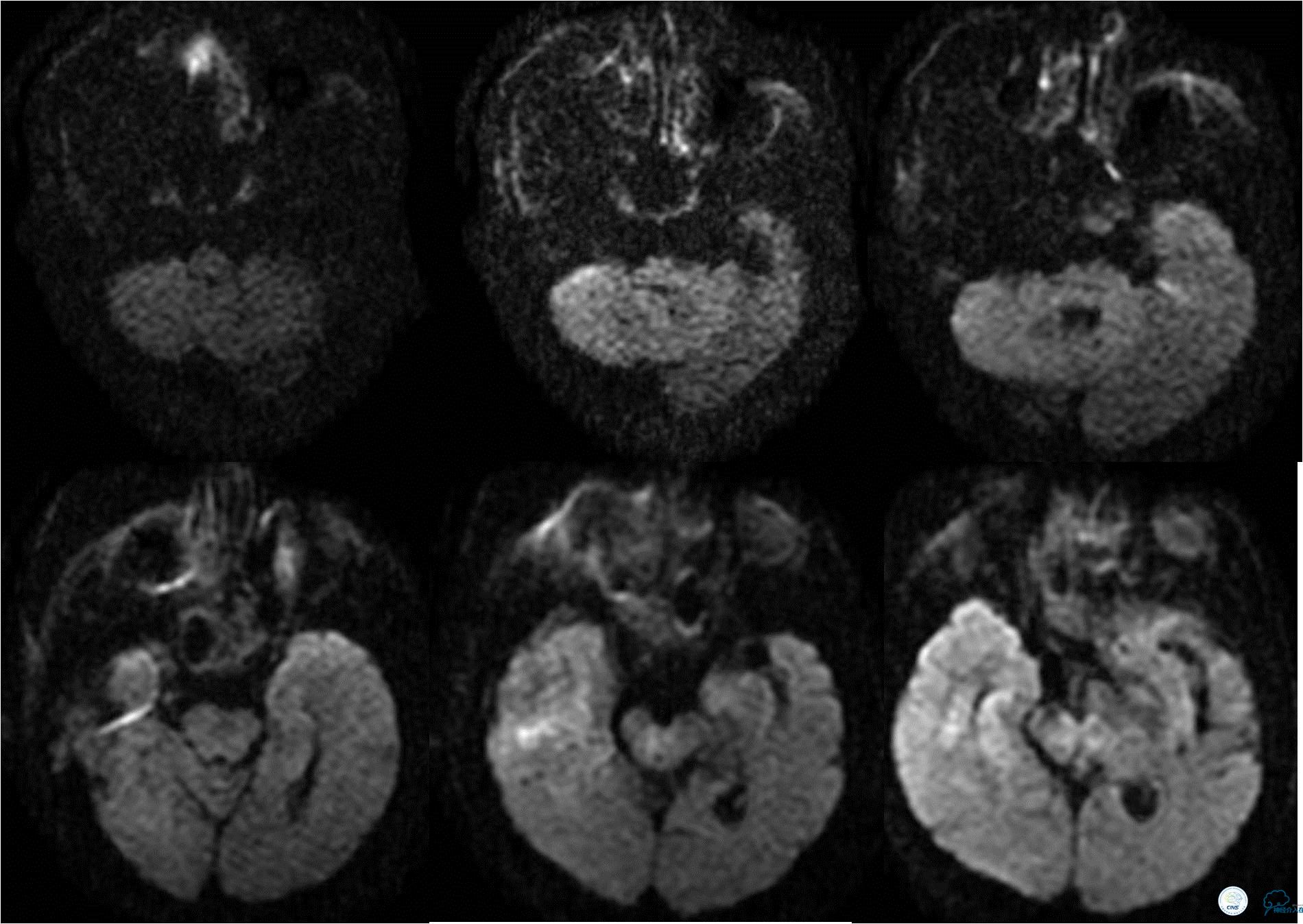 冠状动脉慢性闭塞的介入治疗,颅外段锥动脉狭窄的介入治疗