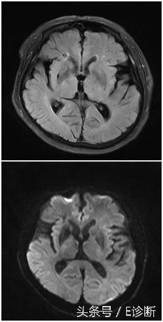 E诊断：脑梗塞影像图解