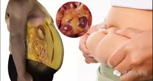 内脏脂肪走高是各种病症导火线！你内脂高了吗？