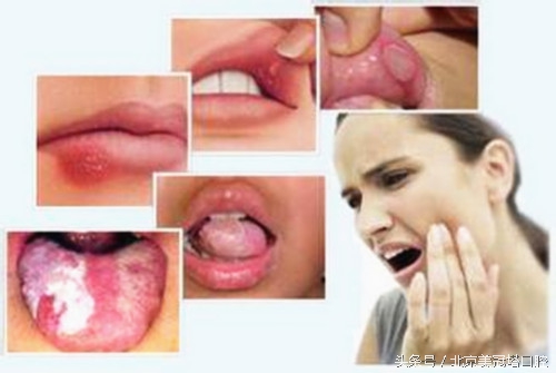 碘酊对口腔粘膜的危害,牙周炎会导致口腔粘膜病变吗