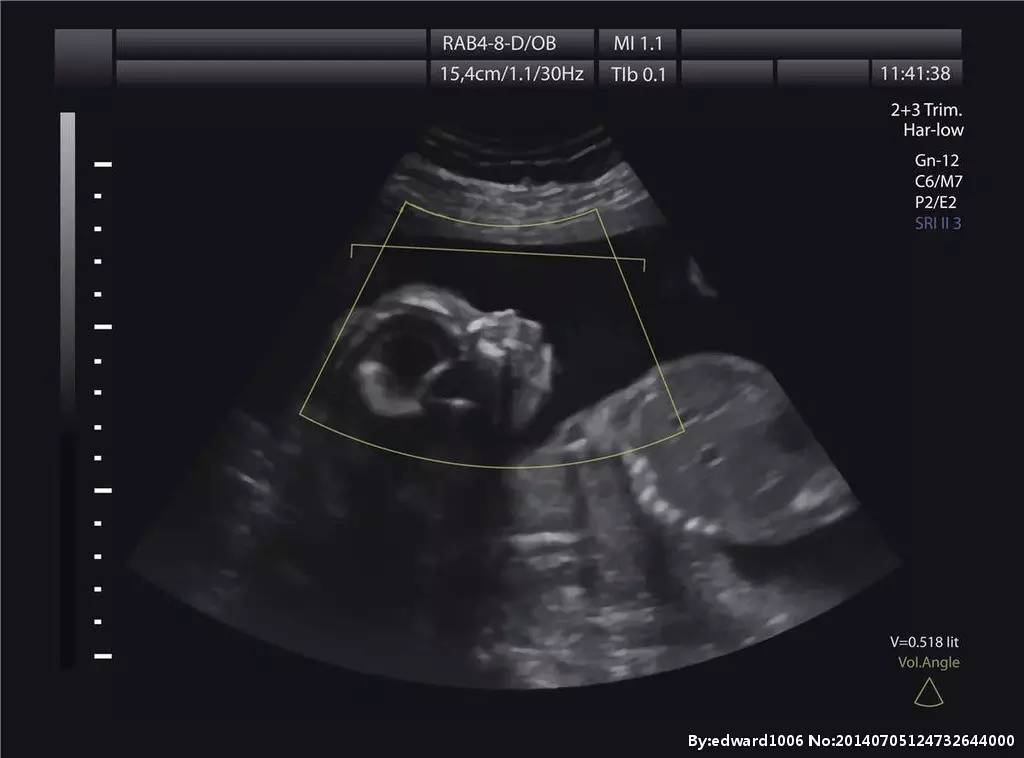 做b超要憋尿是早晨不尿吗,做b超为啥非得憋尿