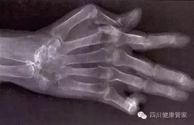 类风湿性关节炎临床典型案例分析,治疗类风湿性关节炎的最好土方法