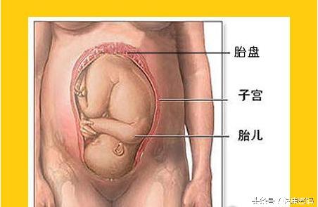 怀孕三个月医生诊断前置胎盘,怀孕时发现是前置胎盘怎么办