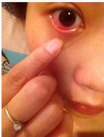 有那种除眼睛血丝的眼药水吗,眼睛有血丝发黄浑浊用什么眼药水