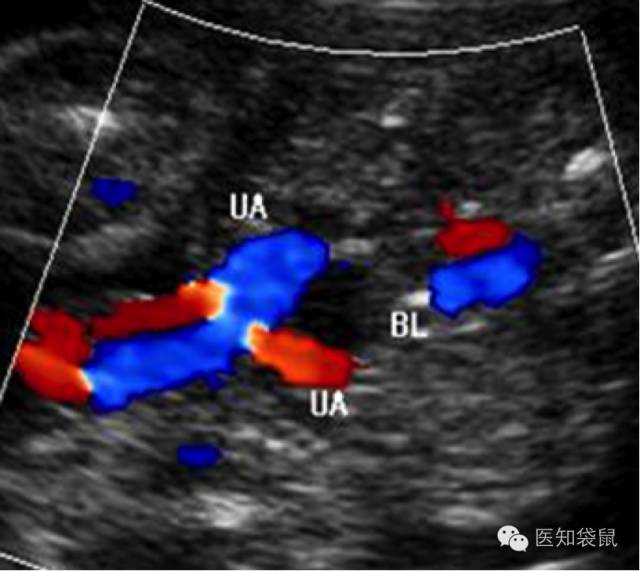 B超三维彩超区别,普通b超能看清胎儿颅内结构吗