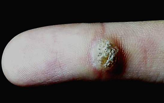 火针灸能治跖疣吗,中医火针治疗丝状疣