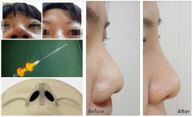 埋线隆鼻和假体隆鼻,鼻梁塌又不想做手术怎么办