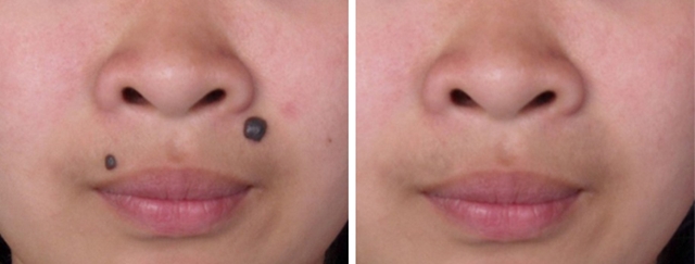 孙红雷黑色素瘤片段,孙红雷黑痣长在什么位置