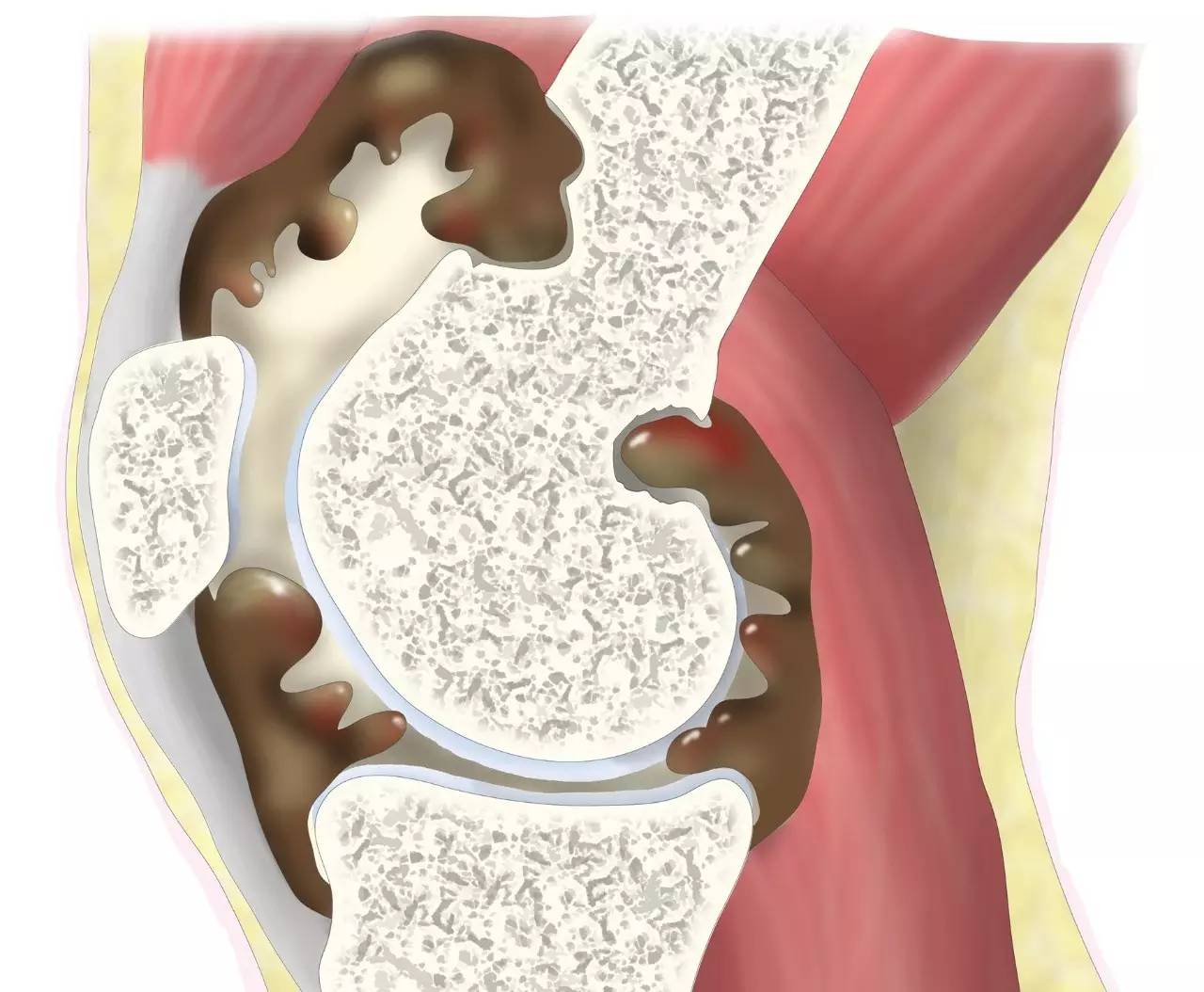 倪海厦治疗膝关节积液,膝关节积液可以热敷吗