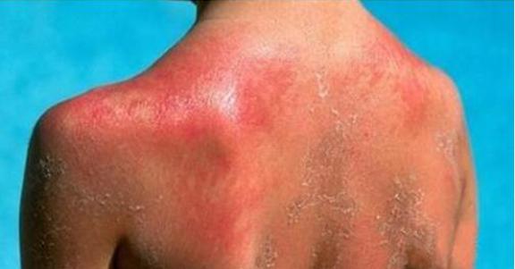 最毁容的皮肤病,最致命最严重的几种皮肤病