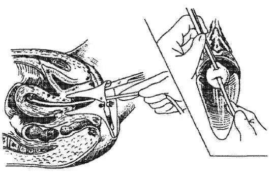 药流和人流可怕吗,关于药流和人流