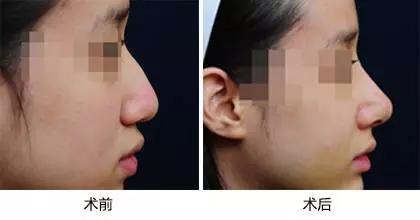 埋线隆鼻和假体隆鼻,鼻梁塌又不想做手术怎么办