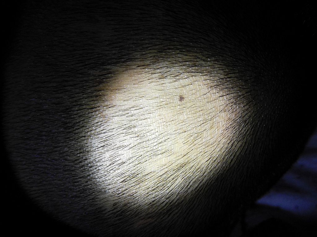 22岁小伙因斑秃或失女友,15年专家临床经验倾囊相授辩证施治