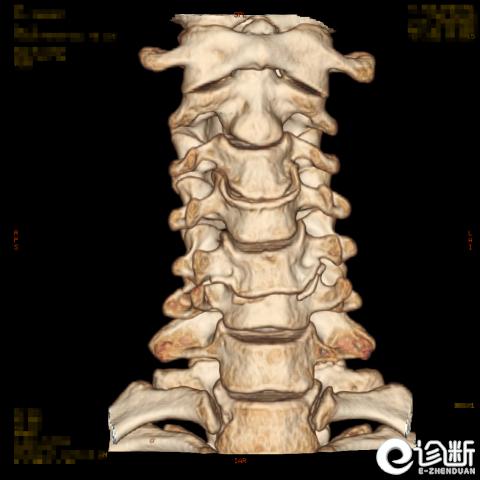 最严重颈椎骨折怎么治疗,ai诊断肋骨骨折