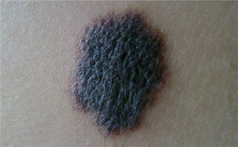 孙红雷谈黑痣长在哪里,孙红雷演的黑痣病变