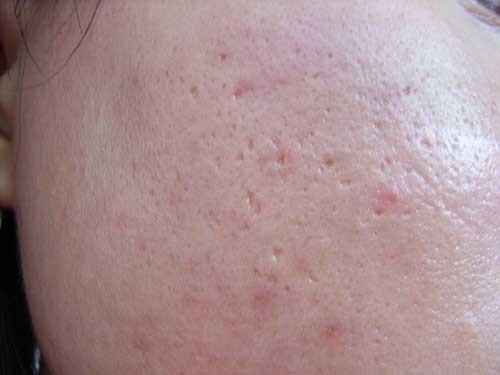 下巴痘坑怎么彻底解决,鼻子的痘坑怎么解决