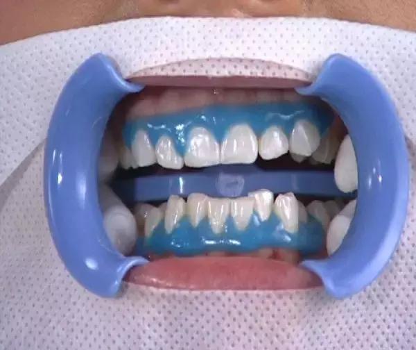 关于牙齿你需要知道的三件事,关于美白那些你不得不知道的事儿