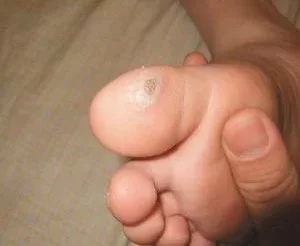 鸡眼病因,鸡眼发病原因与中医治疗