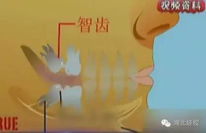 下面的智齿拔了上面的可以不拔吗,下智齿只拔了一侧另一侧不拔行吗