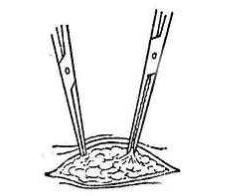 女性结扎以后复通手术全过程,女性结扎的手术步骤