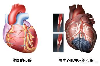 心肌重构能够有效逆转吗,心梗后多长时间心肌重构