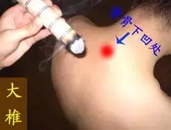 艾灸疗法调理经络不通,艾灸治疗肢体不温