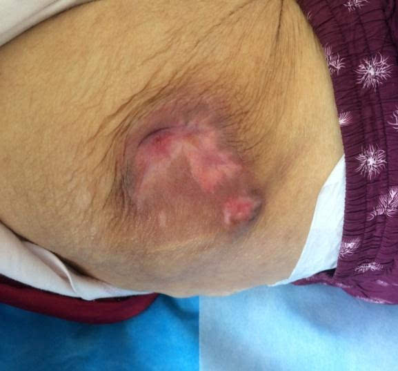 老人长期卧床皮肤有破皮,长期卧床导致皮肤破溃用什么药