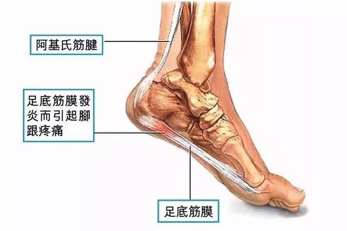 跑步足底筋膜炎后期如何康复训练,足底筋膜炎穿什么鞋跑步