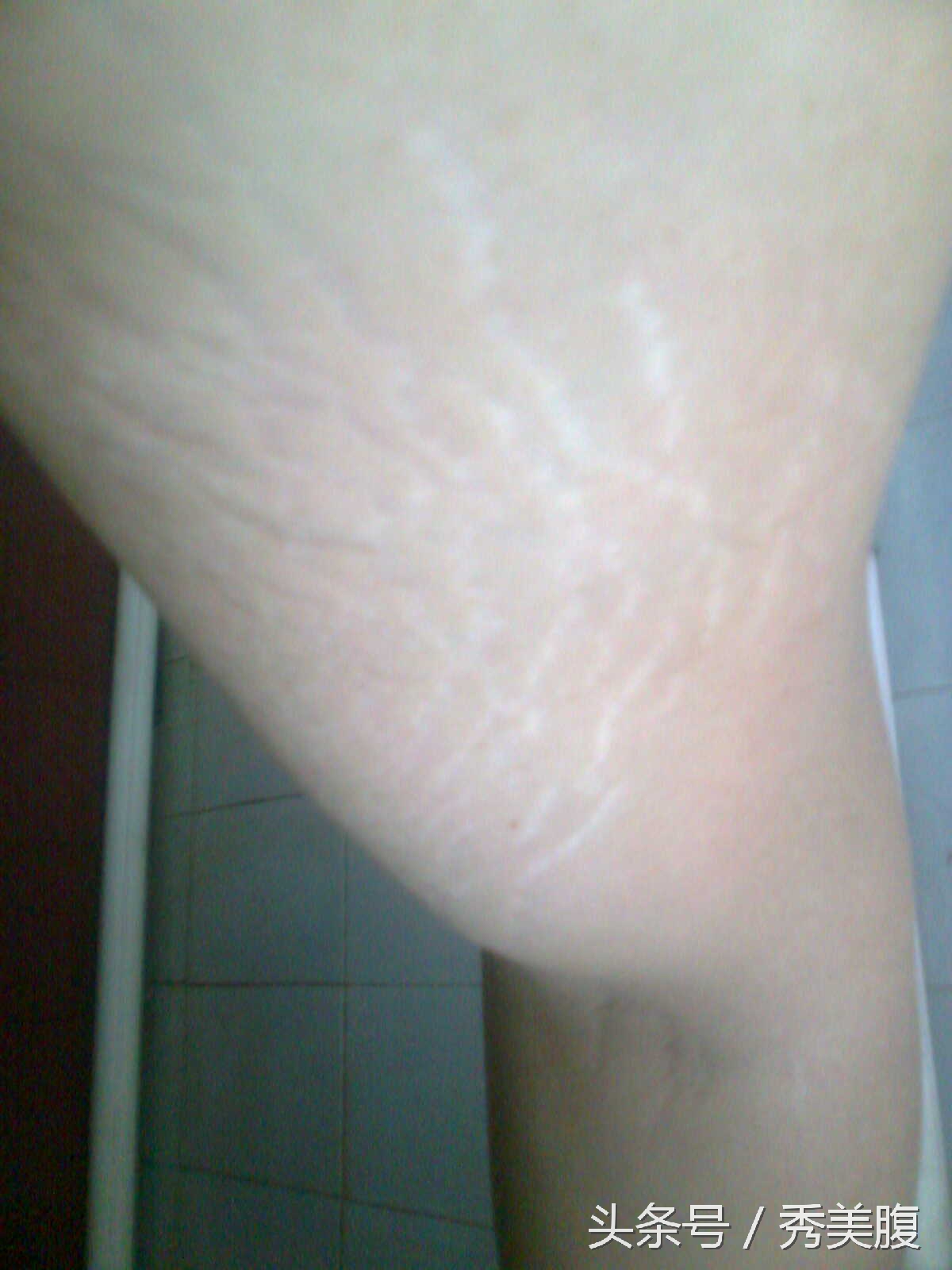 大腿内侧肥胖纹裂开了怎么办,大腿内侧的肥胖纹可以锻炼去除吗